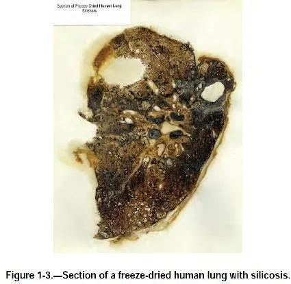 Фрагмент легені, хворої на силікоз. Фото з Вікіпедії